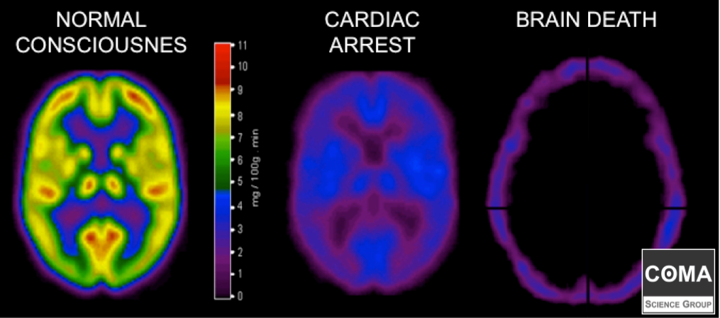 Scans compare neurological activity in a brain that is healthy, one that is comatose and another that is dead