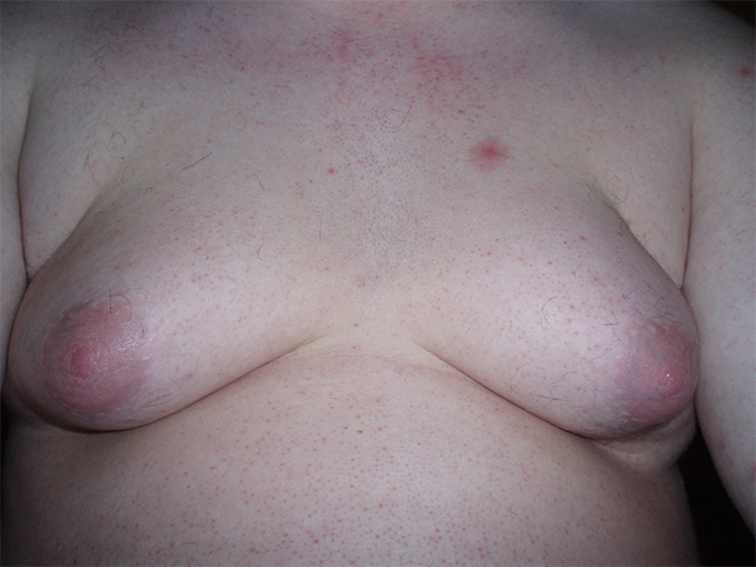 One in two boys develops breasts, physician claims "entirely normal phenomenon" 16