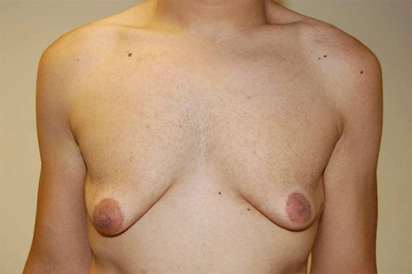 One in two boys develops breasts, physician claims "entirely normal phenomenon" 13