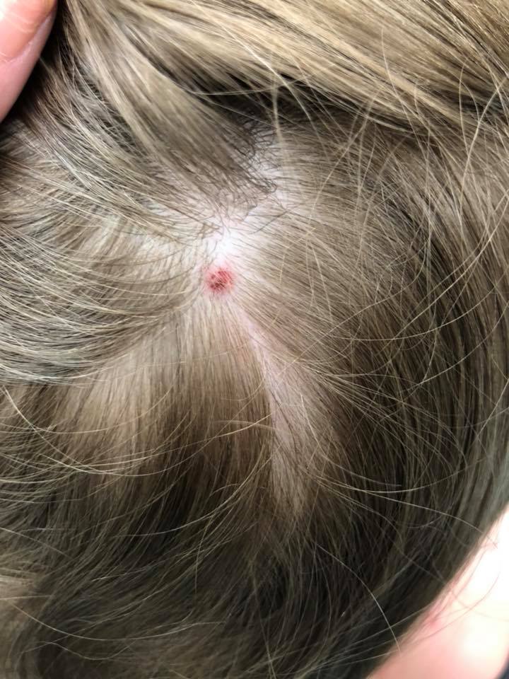 This 5-Year-Old Kid Got The Scariest Tick Bite Side-Effect We've Ever ...